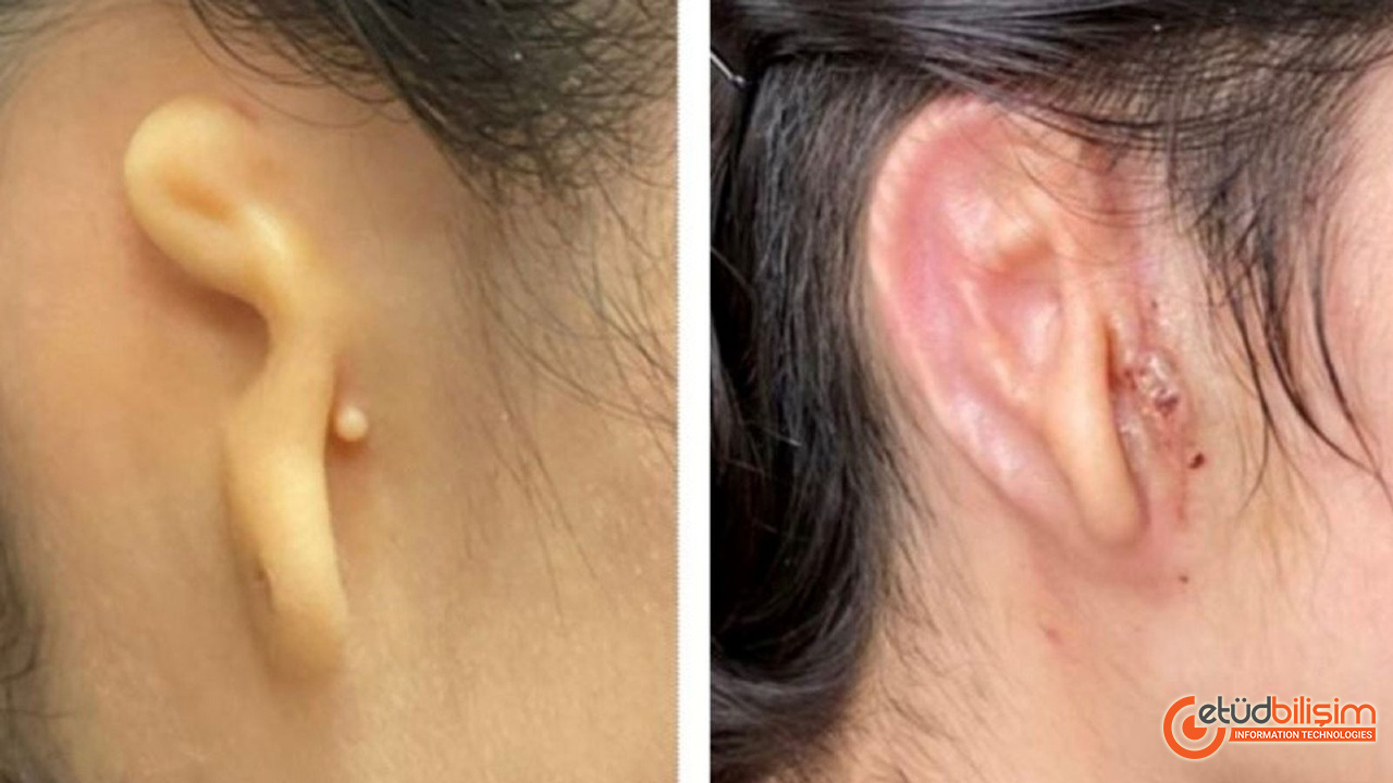 3D Yazıcı İle Yapılan Kulak